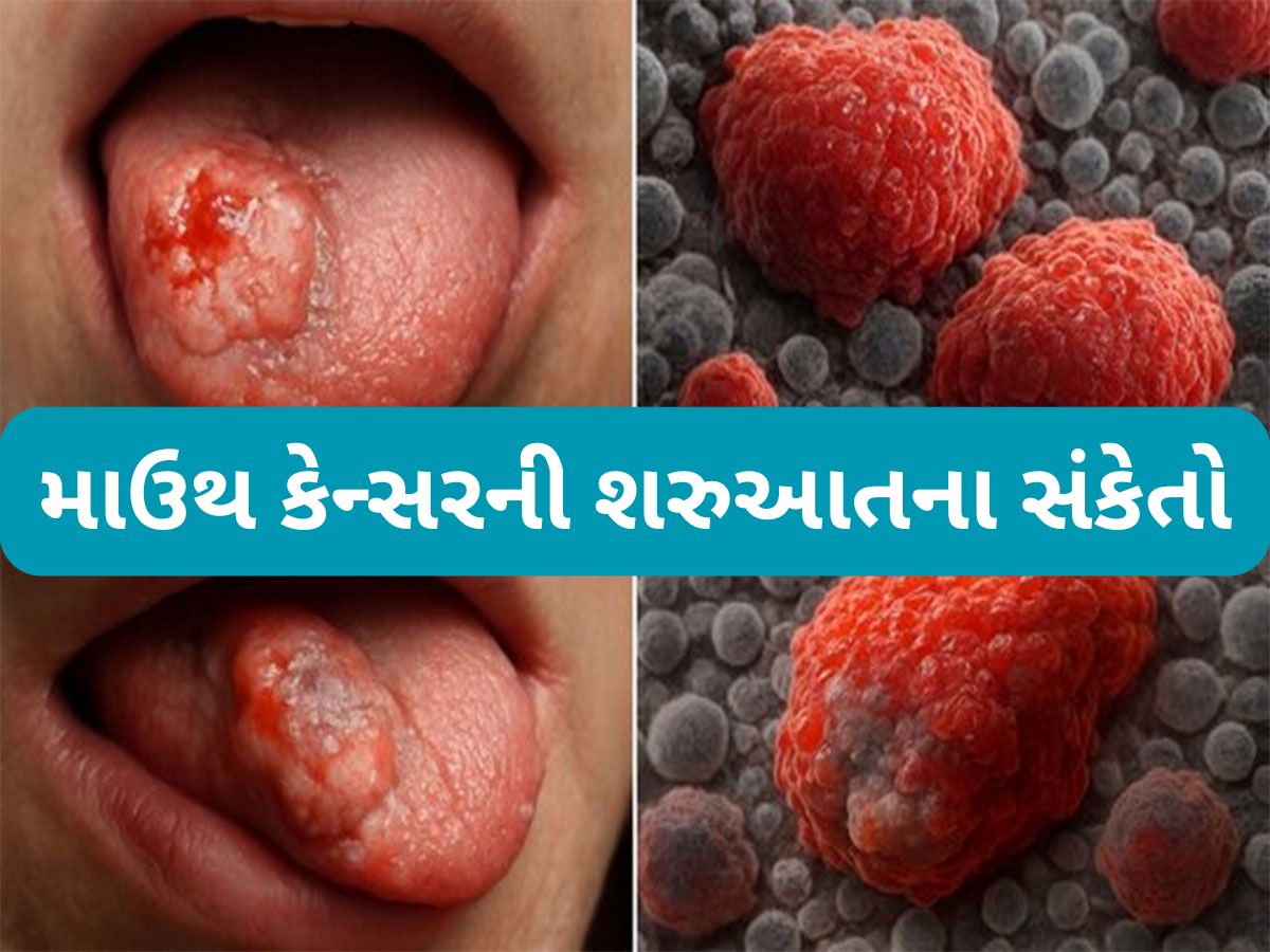 Oral Cancer: મોઢામાં કેન્સર થયું હોય તો શરુઆતમાં દેખાય આ 8 સંકેત, સામાન્ય ગણી ઈગ્નોર ન કરવા આ લક્ષણોને Oral Cancer: મોઢામાં કેન્સર થયું હોય તો શરુઆતમાં દેખાય આ 8 સંકેત, સામાન્ય ગણી ઈગ્નોર ન કરવા આ લક્ષણોને