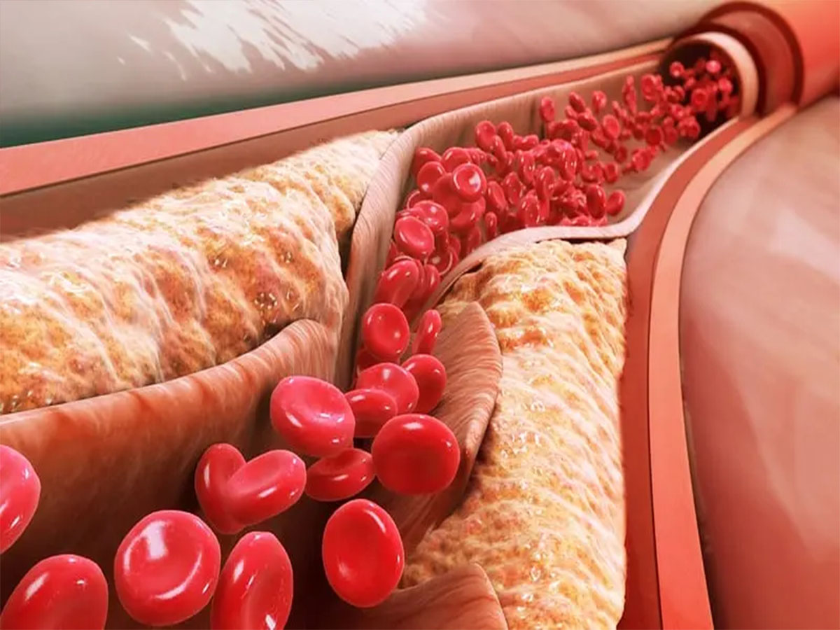 Bad Cholesterol: બેડ કોલેસ્ટ્રોલ વધે ત્યારે આ અંગમાં રહે દુખાવો, જાણો બેડ કોલેસ્ટ્રોલનો આયુર્વેદિક ઈલાજ Bad Cholesterol: બેડ કોલેસ્ટ્રોલ વધે ત્યારે આ અંગમાં રહે દુખાવો, જાણો બેડ કોલેસ્ટ્રોલનો આયુર્વેદિક ઈલાજ