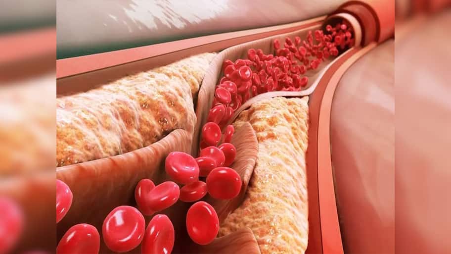 Bad Cholesterol: બેડ કોલેસ્ટ્રોલ વધે ત્યારે આ અંગમાં રહે દુખાવો, જાણો બેડ કોલેસ્ટ્રોલનો આયુર્વેદિક ઈલાજ