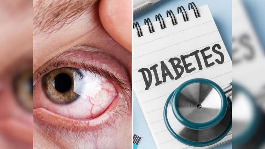 Diabetes: આંખમાં જોવા મળે છે ડાયાબિટીસનું પ્રથમ લક્ષણ, જાણો ક્યારે સાવચેતી રાખવી જરૂરી