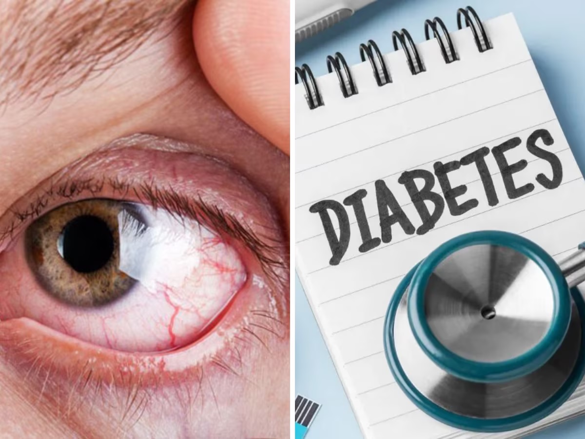 Diabetes: આંખમાં જોવા મળે છે ડાયાબિટીસનું પ્રથમ લક્ષણ, જાણો ક્યારે સાવચેતી રાખવી જરૂરી Diabetes: આંખમાં જોવા મળે છે ડાયાબિટીસનું પ્રથમ લક્ષણ, જાણો ક્યારે સાવચેતી રાખવી જરૂરી