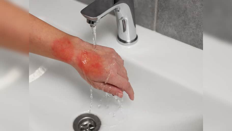 Burn Injury: ગરમ તેલ, વરાળ કે ગેસની આંચ.. કોઈપણ વસ્તુથી દાઝ લાગે તો સૌથી પહેલા આ કામ કરજો, ચામડી પર ફોડલા નહીં પડે