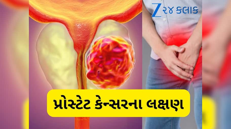 શરીરમાં આ લક્ષણ જોવા મળે તો સમજી લો થઈ ગયું પ્રોસ્ટેટ કેન્સર, સીધા ડોક્ટર પાસે પહોંચો