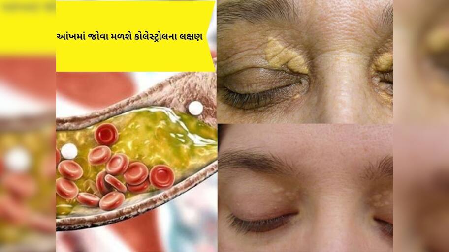 જો આ લક્ષણો આંખોમાં દેખાય છે, તો સમજી જજો, શરીરમાં વધી રહ્યું છે કોલેસ્ટ્રોલ