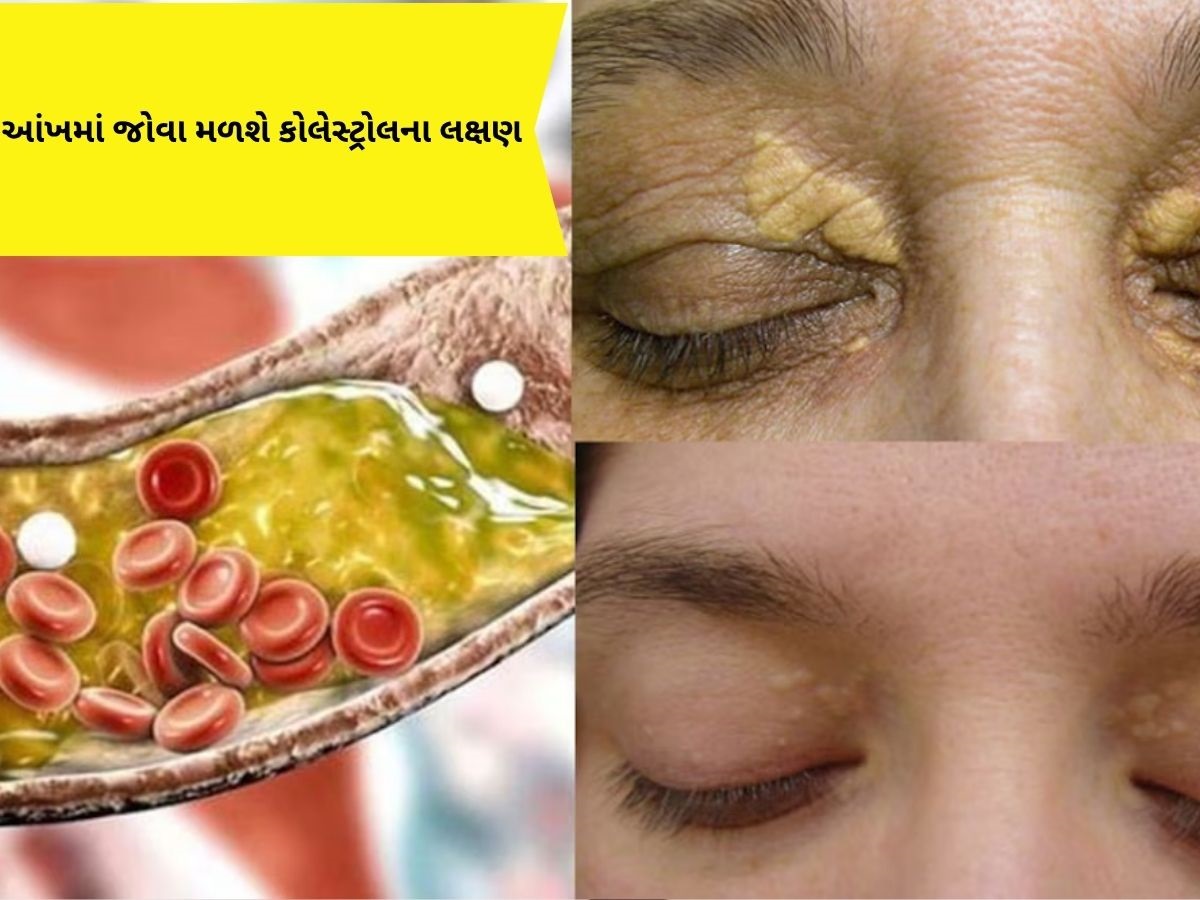જો આ લક્ષણો આંખોમાં દેખાય છે, તો સમજી જજો, શરીરમાં વધી રહ્યું છે કોલેસ્ટ્રોલ જો આ લક્ષણો આંખોમાં દેખાય છે, તો સમજી જજો, શરીરમાં વધી રહ્યું છે કોલેસ્ટ્રોલ