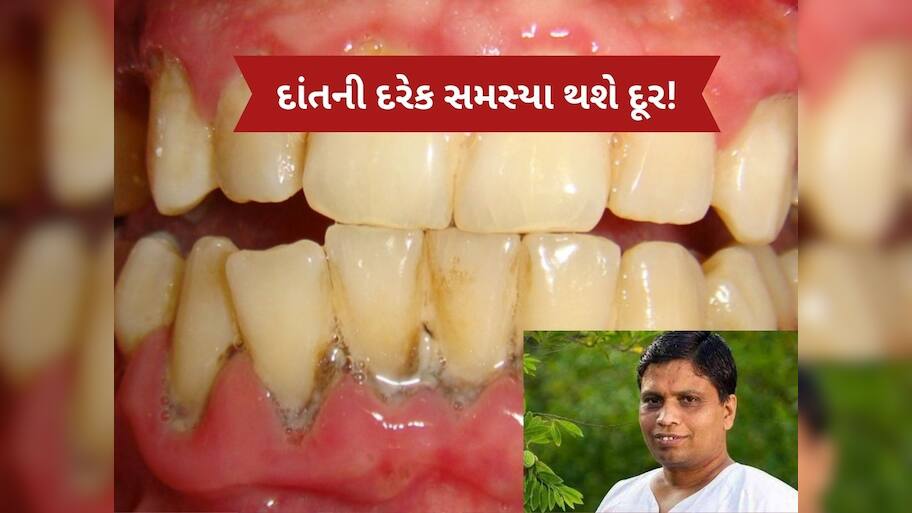  એક-એક દાંત મજબૂત બનશે, મોતી જેવી ચમક આવી જશે, આચાર્ય બાલકૃષ્ણએ જણાવ્યો દેશી ઉપાય
