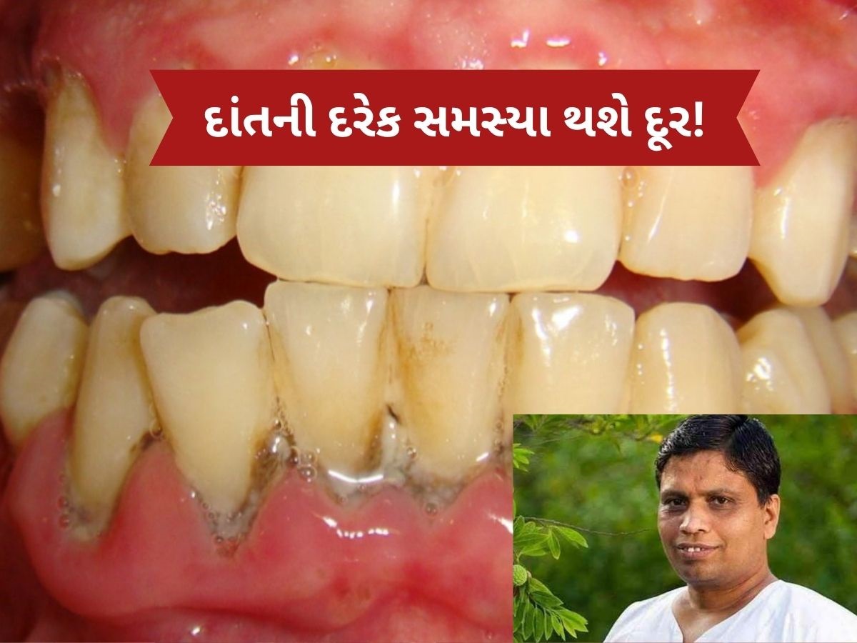 એક-એક દાંત મજબૂત બનશે, મોતી જેવી ચમક આવી જશે, આચાર્ય બાલકૃષ્ણએ જણાવ્યો દેશી ઉપાય એક-એક દાંત મજબૂત બનશે, મોતી જેવી ચમક આવી જશે, આચાર્ય બાલકૃષ્ણએ જણાવ્યો દેશી ઉપાય