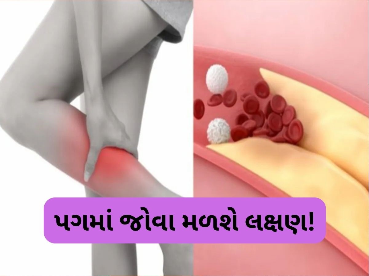 તમારા પગ જ આપશે હાઈકોલેસ્ટ્રોલના સંકેતો, નજરઅંદાજ કરશો તો ભારે પડશે તમારા પગ જ આપશે હાઈકોલેસ્ટ્રોલના સંકેતો, નજરઅંદાજ કરશો તો ભારે પડશે