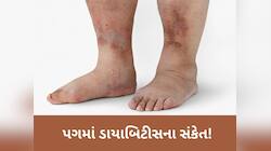 પગમાં આ લક્ષણો જોવા મળે તો ડોક્ટર પાસે પહોંચી જજો, ડાયાબિટીસનો હોઈ શકે છે સંકેત!