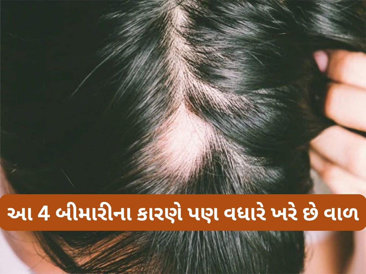Hair Fall: શેમ્પૂ કે પાણીના કારણે જ નહીં, શરીરમાં આ 4 બીમારી વધતી હોય તો પણ ખરવા લાગે છે વાળ Hair Fall: શેમ્પૂ કે પાણીના કારણે જ નહીં, શરીરમાં આ 4 બીમારી વધતી હોય તો પણ ખરવા લાગે છે વાળ