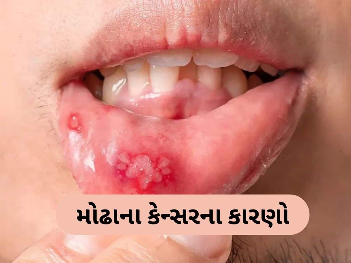  આ છે મોઢાના કેન્સરના વિચિત્ર કારણ! વ્યસન ન હોય તે લોકો પણ આવે છે ઝપેટમાં
