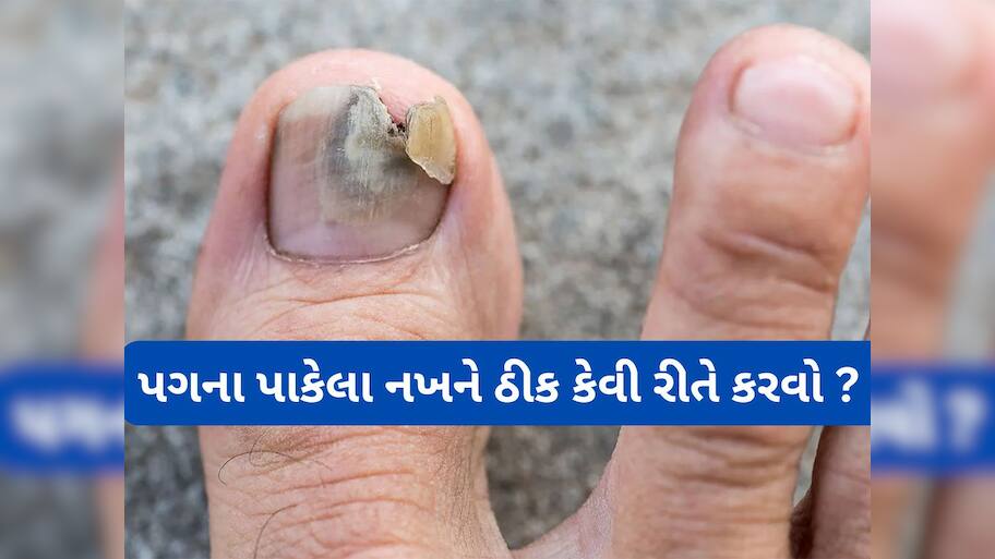 Nail Infection: અંગુઠાનો નખ પાકે તો શું કરવું ? કાળા કે પીળા પડેલા નખને નોર્મલ કરવાનો અસરકારક નુસખો