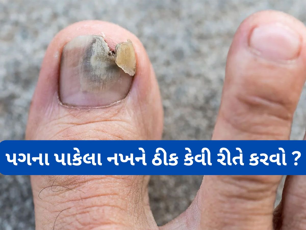 Nail Infection: અંગુઠાનો નખ પાકે તો શું કરવું ? કાળા કે પીળા પડેલા નખને નોર્મલ કરવાનો અસરકારક નુસખો Nail Infection: અંગુઠાનો નખ પાકે તો શું કરવું ? કાળા કે પીળા પડેલા નખને નોર્મલ કરવાનો અસરકારક નુસખો