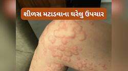 શરીરમાં અચાનક શીળસ નીકળે તો લગાડો આમાંથી કોઈ 1 વસ્તુ, તુરંત રાહત કરશે આ ઘરેલુ ઉપાય