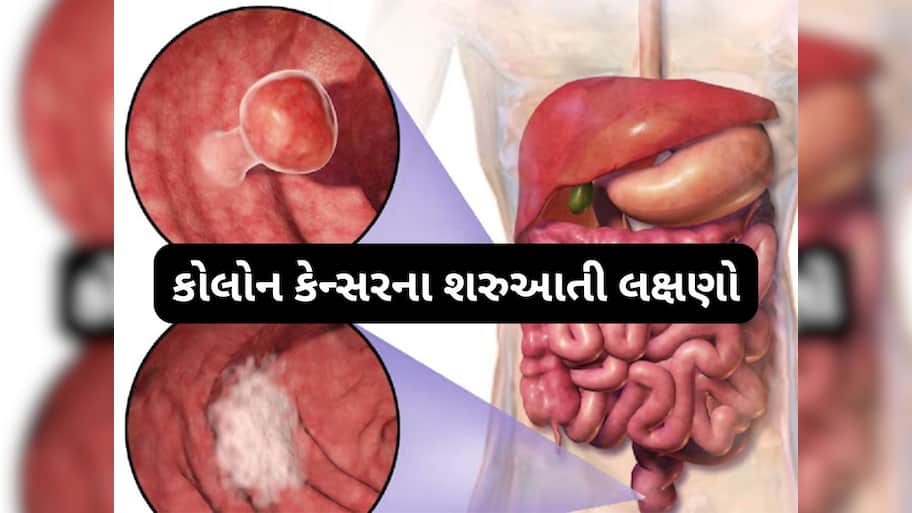 Colon Cancer: સવારે બાથરુમમાં દેખાય છે આંતરડાના કેન્સરની શરુઆતનું પહેલું લક્ષણ, ઈગ્નોર કરશો તો હેરાન થઈ જશો