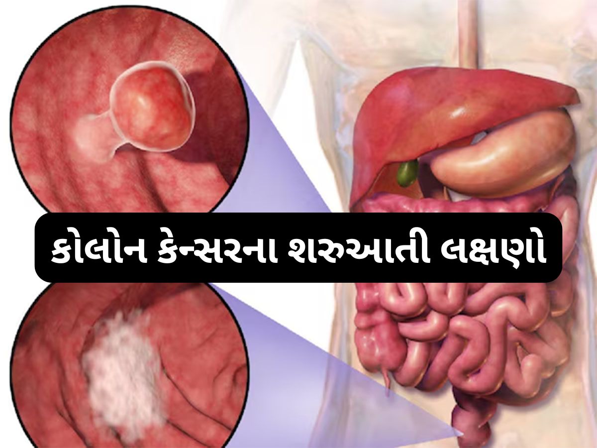 Colon Cancer: સવારે બાથરુમમાં દેખાય છે આંતરડાના કેન્સરની શરુઆતનું પહેલું લક્ષણ, ઈગ્નોર કરશો તો હેરાન થઈ જશો Colon Cancer: સવારે બાથરુમમાં દેખાય છે આંતરડાના કેન્સરની શરુઆતનું પહેલું લક્ષણ, ઈગ્નોર કરશો તો હેરાન થઈ જશો