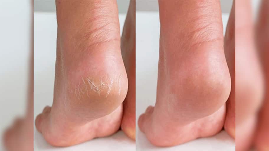 Cracked Heels: ડ્રાય અને ફાટેલી એડી 7 દિવસમાં થઈ જશે ઠીક, રોજ રાત્રે ઘરે બનાવેલું આ તેલ લગાડવું