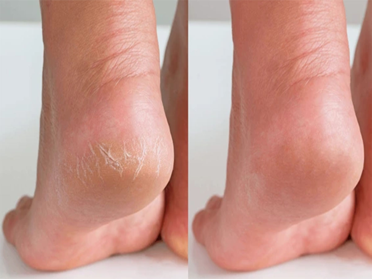 Cracked Heels: ડ્રાય અને ફાટેલી એડી 7 દિવસમાં થઈ જશે ઠીક, રોજ રાત્રે ઘરે બનાવેલું આ તેલ લગાડવું Cracked Heels: ડ્રાય અને ફાટેલી એડી 7 દિવસમાં થઈ જશે ઠીક, રોજ રાત્રે ઘરે બનાવેલું આ તેલ લગાડવું