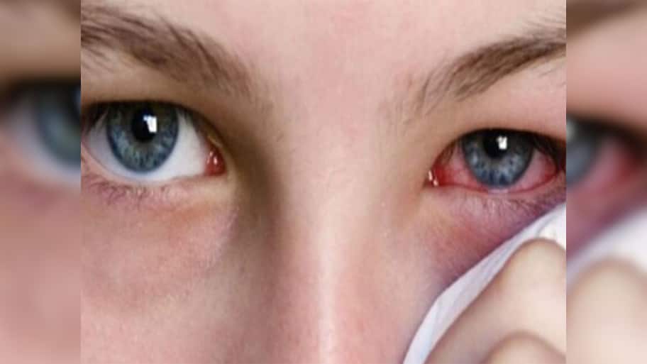 Eye Flu: આંખ આવે તો ઘરે કેવી રીતે ઈલાજ કરવો ? કઈ વસ્તુથી તુરંત મળે આરામ જાણો