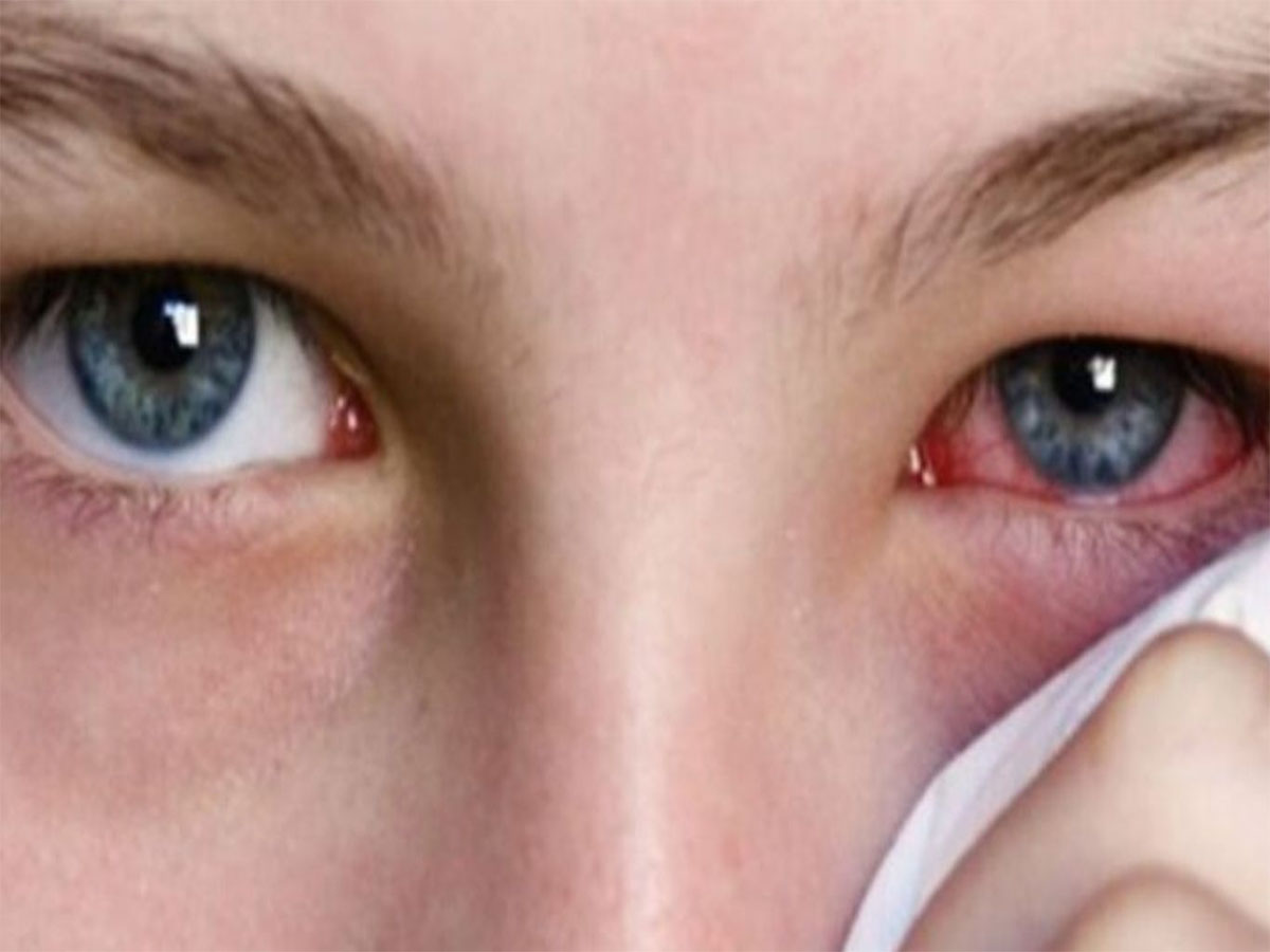 Eye Flu: આંખ આવે તો ઘરે કેવી રીતે ઈલાજ કરવો ? કઈ વસ્તુથી તુરંત મળે આરામ જાણો Eye Flu: આંખ આવે તો ઘરે કેવી રીતે ઈલાજ કરવો ? કઈ વસ્તુથી તુરંત મળે આરામ જાણો