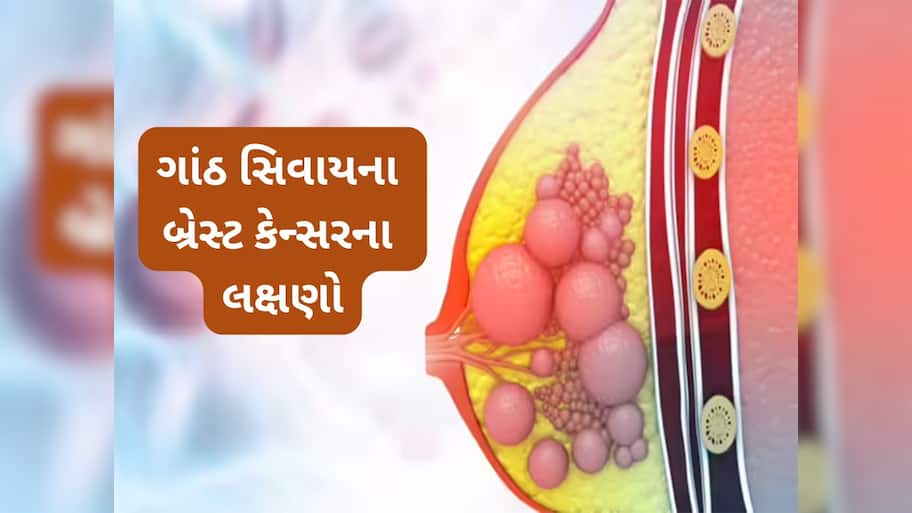 Breast Cancer: ગાંઠ સિવાયના બ્રેસ્ટ કેન્સરના લક્ષણો, મોટાભાગની મહિલાઓ અજાણતા કરી દે છે ઈગ્નોર