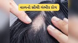 આ છે વાળનો સૌથી ગંભીર રોગ, માથામાંથી ગુચ્છામાં ખરી જાય વાળ, જાણો આ રોગ થવાના કારણો