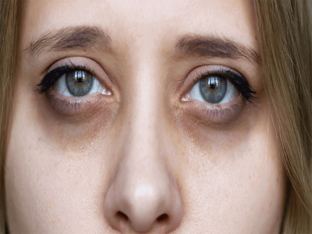 Dark Circles: આ 3 ખામી દુર કરી દેશો તો કાયમ માટે દુર થઈ જશે ડાર્ક સર્કલ Dark Circles: આ 3 ખામી દુર કરી દેશો તો કાયમ માટે દુર થઈ જશે ડાર્ક સર્કલ
