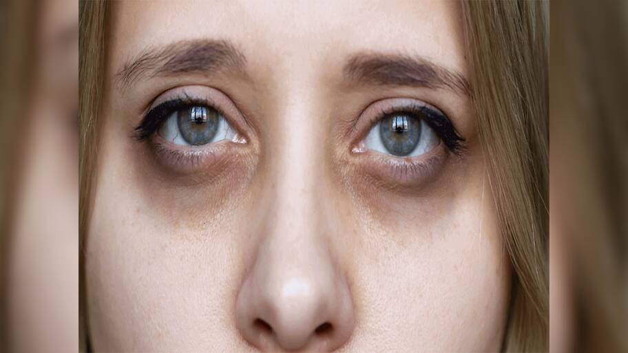 Dark Circles: આ 3 ખામી દુર કરી દેશો તો કાયમ માટે દુર થઈ જશે ડાર્ક સર્કલ