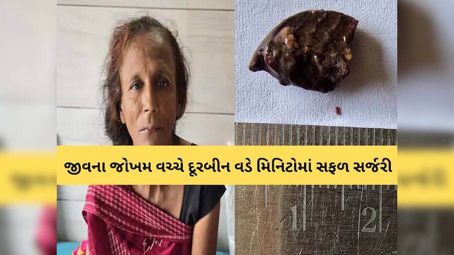 જીવના જોખમ વચ્ચે મહિલા દર્દીને નવજીવન! અન્નનળીમાં ફસાયેલ ધારદાર સોપારીનો ટુકડો કાઢ્યો, ડોક્ટરની અનોખી સિદ્ધિ