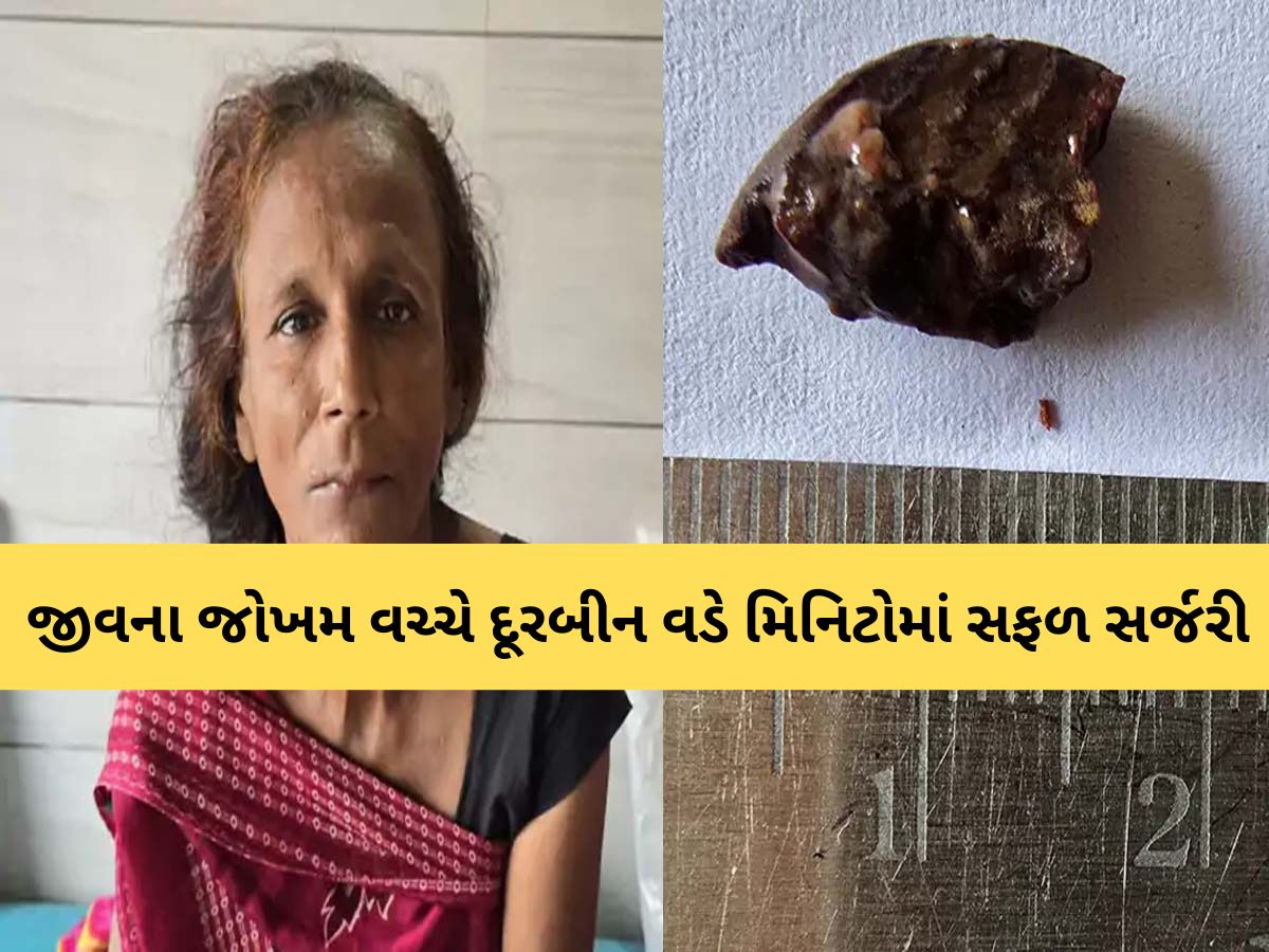 જીવના જોખમ વચ્ચે મહિલા દર્દીને નવજીવન! અન્નનળીમાં ફસાયેલ ધારદાર સોપારીનો ટુકડો કાઢ્યો, ડોક્ટરની અનોખી સિદ્ધિ જીવના જોખમ વચ્ચે મહિલા દર્દીને નવજીવન! અન્નનળીમાં ફસાયેલ ધારદાર સોપારીનો ટુકડો કાઢ્યો, ડોક્ટરની અનોખી સિદ્ધિ
