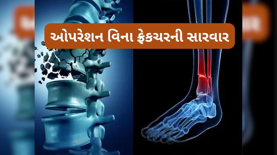 Bone Glue China: બસ 2 મિનિટમાં સર્જરી વિના જોડાય જાશે તૂટેલું હાડકું, બની ગયું દુનિયાનું પહેલું બોન ગ્લૂ