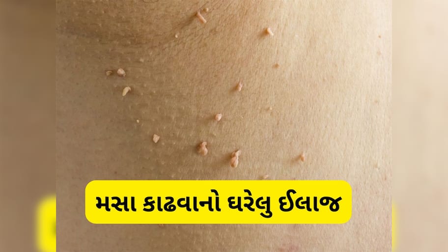 Skin Care: ઘરમાં રહેલી આ 3 વસ્તુથી નીકળી શકે છે ચામડી પરના મસા, દુખાવા વિના મસાથી મળશે છુટકારો