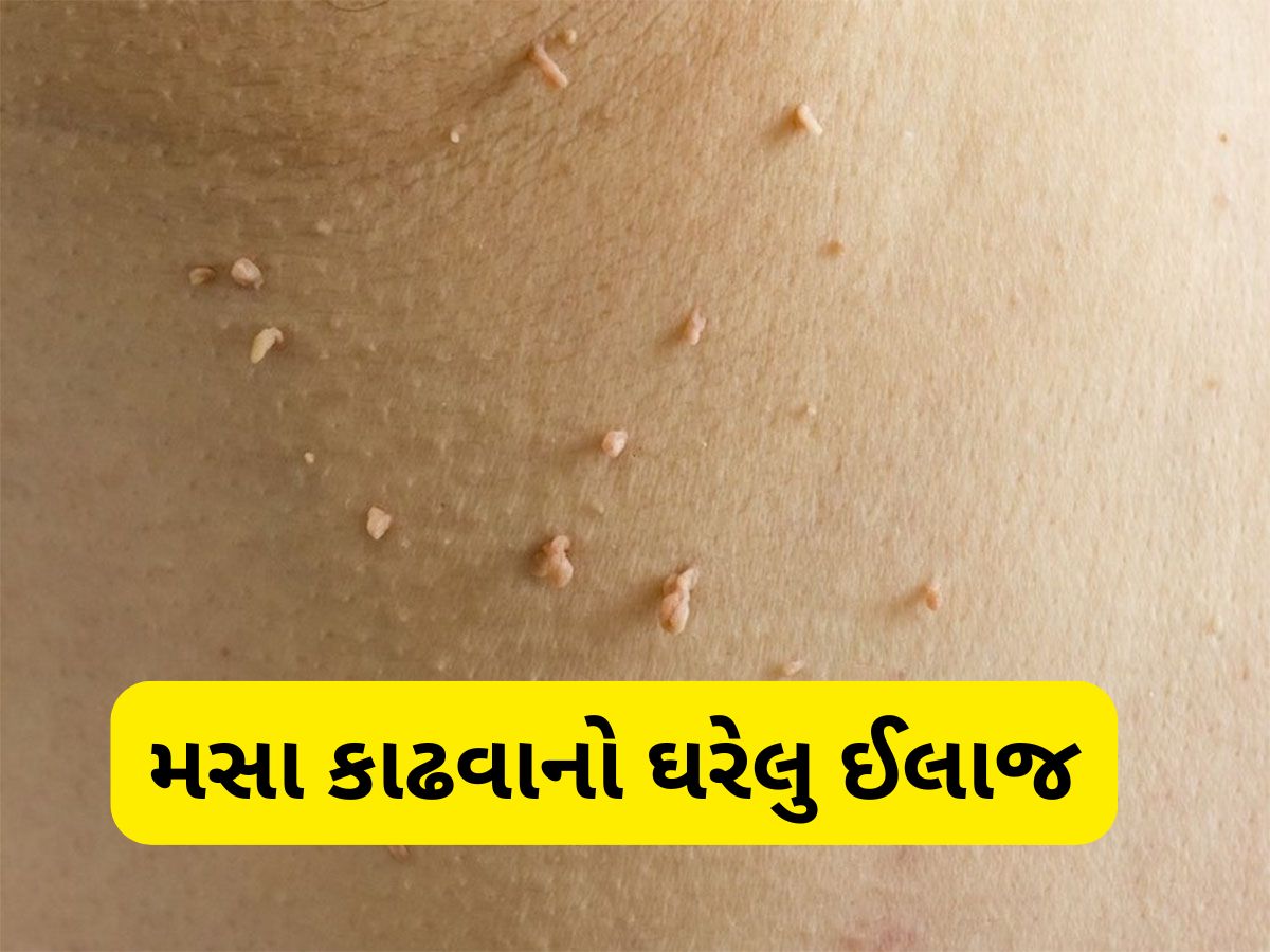 Skin Care: ઘરમાં રહેલી આ 3 વસ્તુથી નીકળી શકે છે ચામડી પરના મસા, દુખાવા વિના મસાથી મળશે છુટકારો Skin Care: ઘરમાં રહેલી આ 3 વસ્તુથી નીકળી શકે છે ચામડી પરના મસા, દુખાવા વિના મસાથી મળશે છુટકારો