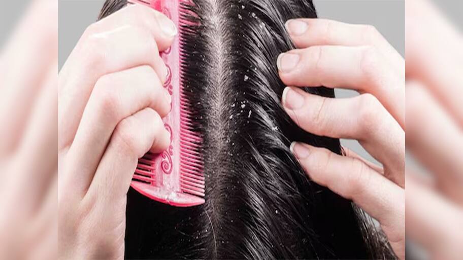 Dandruff: ડેન્ડ્રફથી છુટકારો મેળવવા ટ્રાય કરો દાદી-નાનીના આ 5 ઘરેલુ નુસખા