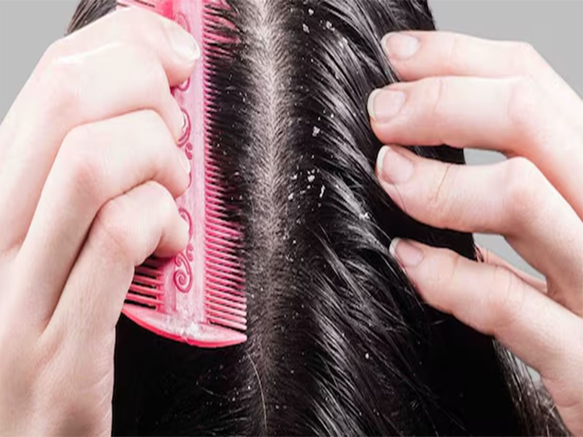 Dandruff: ડેન્ડ્રફથી છુટકારો મેળવવા ટ્રાય કરો દાદી-નાનીના આ 5 ઘરેલુ નુસખા Dandruff: ડેન્ડ્રફથી છુટકારો મેળવવા ટ્રાય કરો દાદી-નાનીના આ 5 ઘરેલુ નુસખા