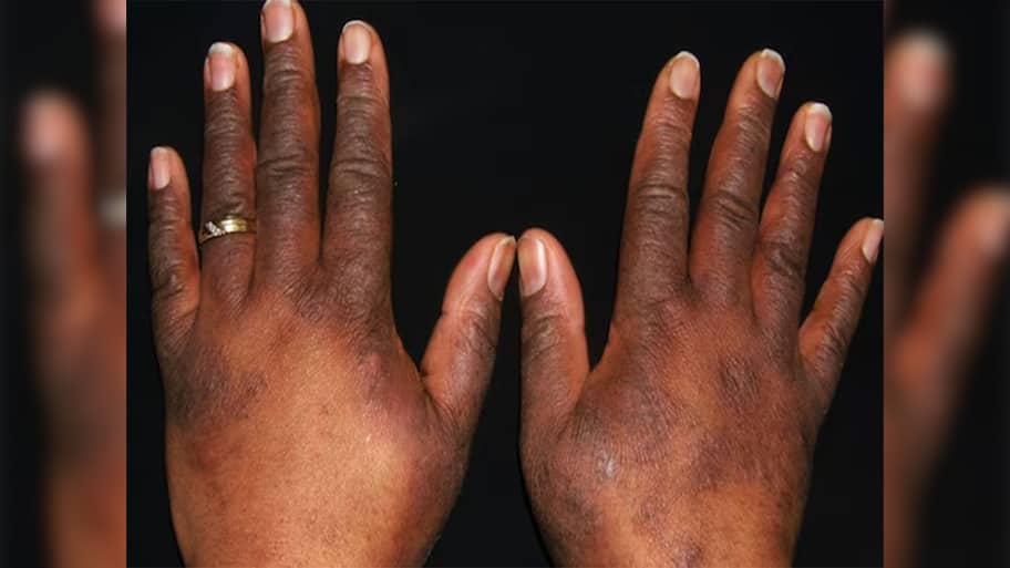Dark Hands: હાથની સ્કિન કાળી થઈ ગઈ છે ? તો અપનાવો આ 5 માંથી કોઈ એક નુસખો, રૂપાળી થઈ જશે ચામડી