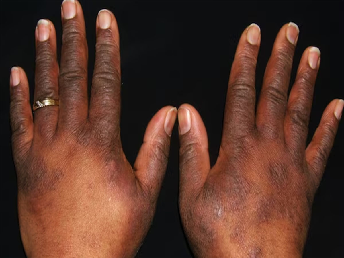 Dark Hands: હાથની સ્કિન કાળી થઈ ગઈ છે ? તો અપનાવો આ 5 માંથી કોઈ એક નુસખો, રૂપાળી થઈ જશે ચામડી Dark Hands: હાથની સ્કિન કાળી થઈ ગઈ છે ? તો અપનાવો આ 5 માંથી કોઈ એક નુસખો, રૂપાળી થઈ જશે ચામડી