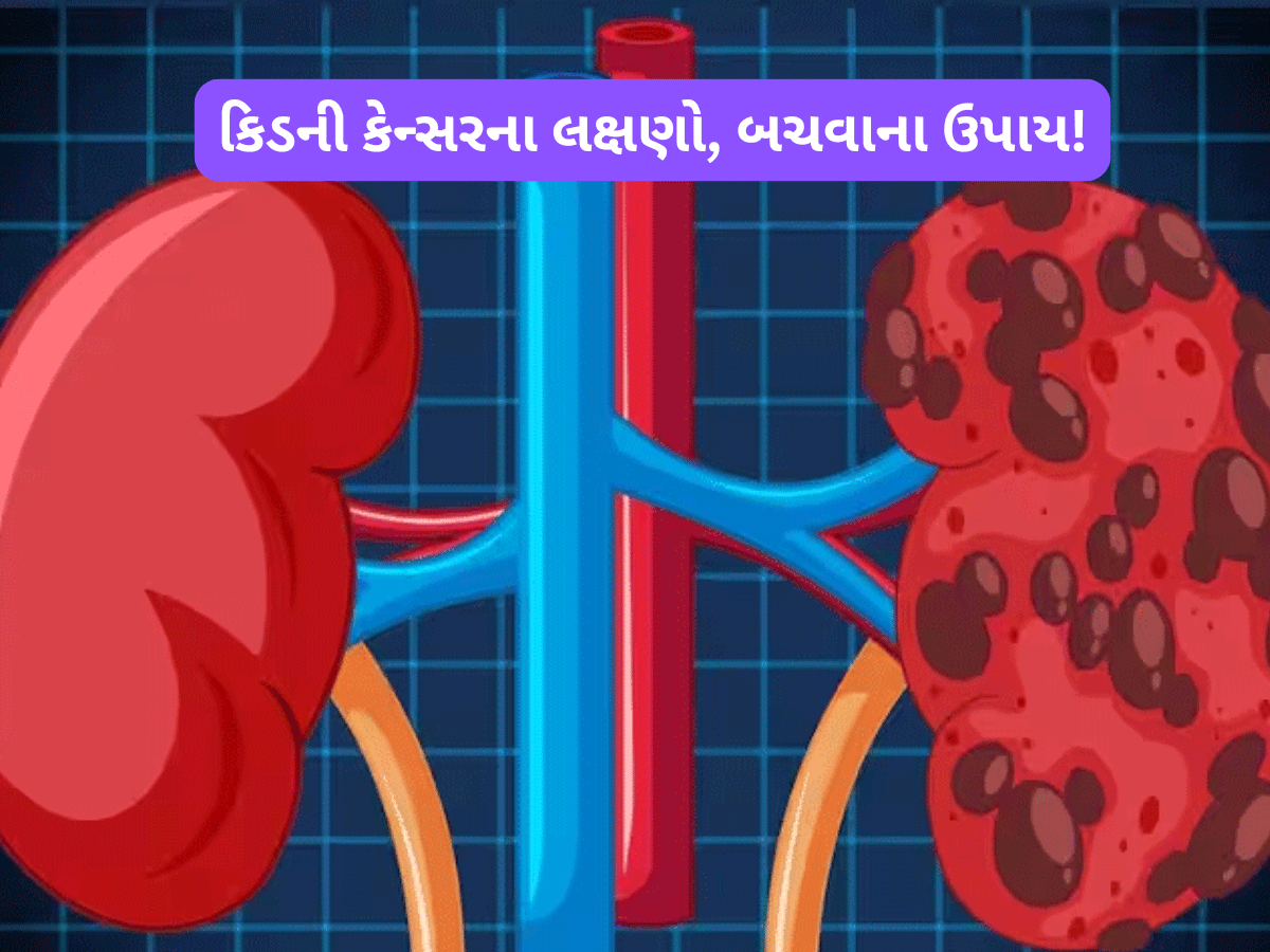 Kidney Cancer: કિડની કેન્સર થતા પહેલા જોવા મળે છે આ 3 લક્ષણ, જાણો કેવી રીતે બચી શકો