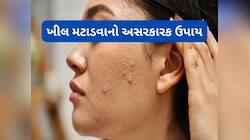 એલોવેરામાં આ 2 વસ્તુ મિક્સ કરી ખીલ પર રાત્રે લગાડો, સવારે સ્કિન હશે એકદમ ક્લીયર