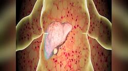 Fatty Liver: લીવર ફેટને ઓગાળી નાખશે આ ડ્રિંક, જાણો બનાવવાની અને પીવાની સાચી રીત