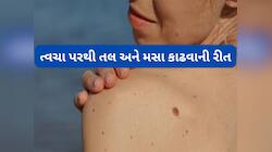કોઈપણ જાતના ખર્ચ વિના ત્વચા પરથી હટાવો તલ અને મસા, અપનાવો એક્સપર્ટે જણાવેલા નુસખા