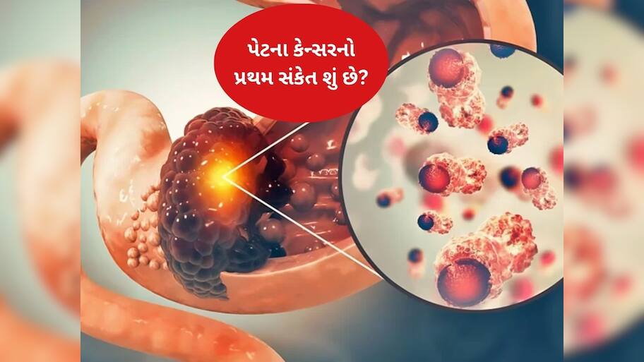  પેટનું કેન્સર થવા પર શરૂઆતમાં જોવા મળે છે આ ગંભીર લક્ષણ, સામાન્ય સમજવાની ભૂલ ન કરો