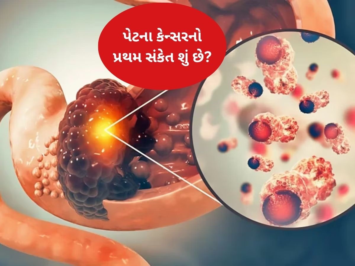 પેટનું કેન્સર થવા પર શરૂઆતમાં જોવા મળે છે આ ગંભીર લક્ષણ, સામાન્ય સમજવાની ભૂલ ન કરો પેટનું કેન્સર થવા પર શરૂઆતમાં જોવા મળે છે આ ગંભીર લક્ષણ, સામાન્ય સમજવાની ભૂલ ન કરો