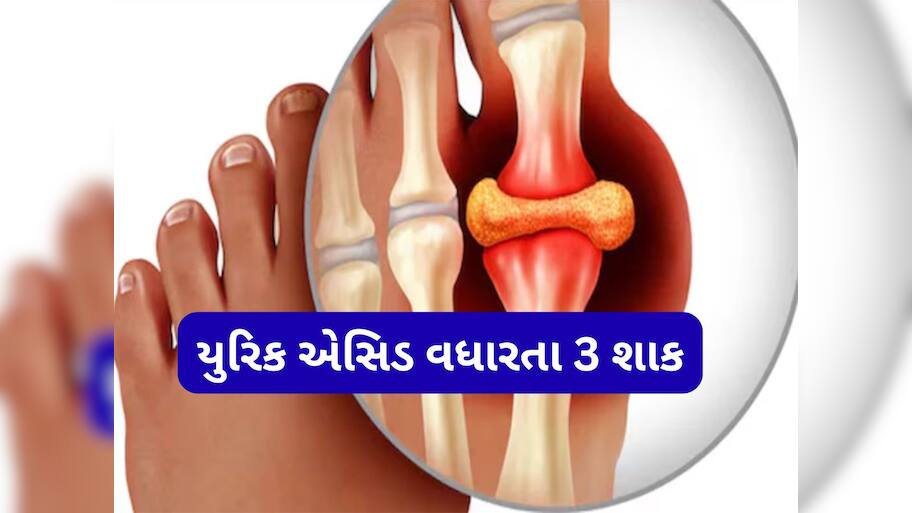 Uric Acid: યુરિક એસિડના દર્દીએ શિયાળામાં ન ખાવા આ 3 શાક, અસહ્ય થઈ જશે સાંધાનો દુખાવો