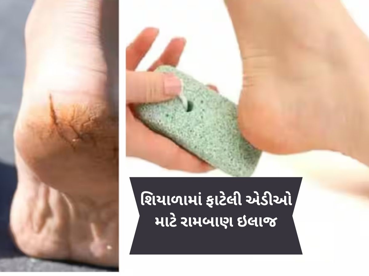 શિયાળામાં ફાટવા લાગી છે એડીઓ, મોંઘી ક્રીમ નહીં આ ઘરેલું નુસ્ખા અજમાવો
