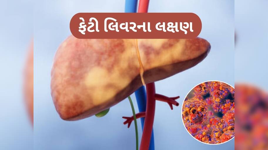  ફેટી લિવરને કારણે શરીરના આ ભાગમાં થાય છે દુખાવો, સામાન્ય લક્ષણ સમજી નજરઅંદાજ ન કરો