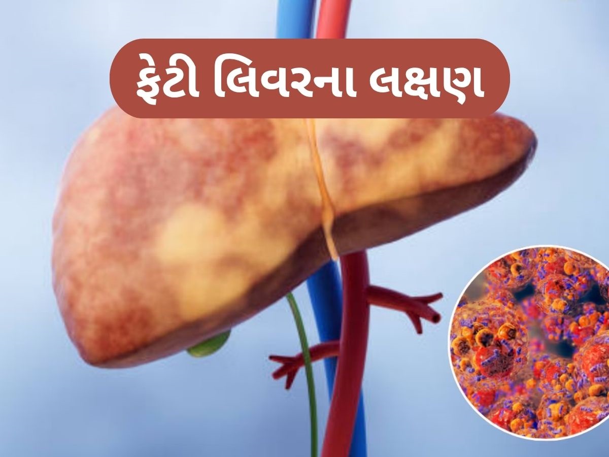 ફેટી લિવરને કારણે શરીરના આ ભાગમાં થાય છે દુખાવો, સામાન્ય લક્ષણ સમજી નજરઅંદાજ ન કરો ફેટી લિવરને કારણે શરીરના આ ભાગમાં થાય છે દુખાવો, સામાન્ય લક્ષણ સમજી નજરઅંદાજ ન કરો