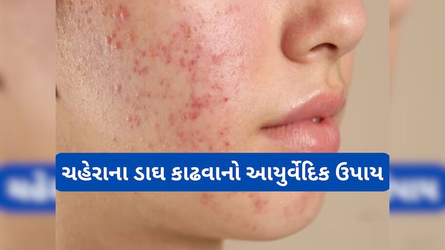 Beauty Tips: પિંપલ અને એક્નેના ડાઘ દુર કરી દેશે આ આયુર્વેદિક ડ્રિંક, ચહેરાની સ્કિન થઈ જશે એકદમ સાફ