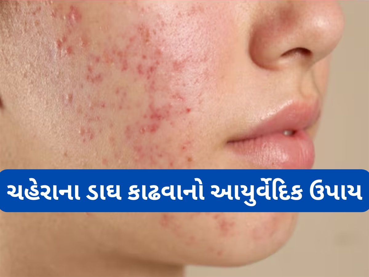 Beauty Tips: પિંપલ અને એક્નેના ડાઘ દુર કરી દેશે આ આયુર્વેદિક ડ્રિંક, ચહેરાની સ્કિન થઈ જશે એકદમ સાફ Beauty Tips: પિંપલ અને એક્નેના ડાઘ દુર કરી દેશે આ આયુર્વેદિક ડ્રિંક, ચહેરાની સ્કિન થઈ જશે એકદમ સાફ