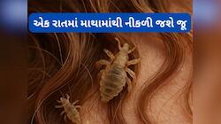 Head Lice: એક રાતમાં નીકળી જશે માથામાંથી જૂ, અજમાવી જુઓ નાળિયેર તેલનો આ નુસખો